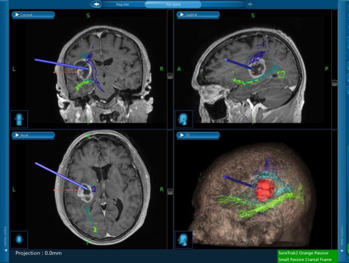 Caltanissetta, intervento neurochirurgico con l’aiuto della trattografia